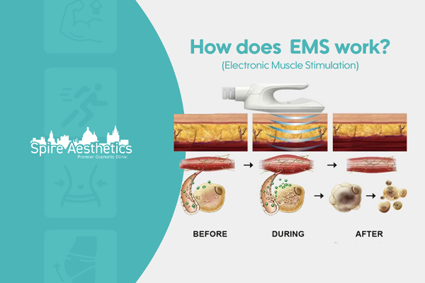 EMS treatment for post pregnancy weight loss treatment Hampton