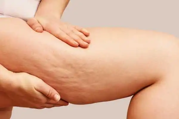 Image of woman showing leg with cellulite Hampton