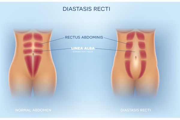 What Non-Surgical Options Are Available for Diastasis Recti Hampton?