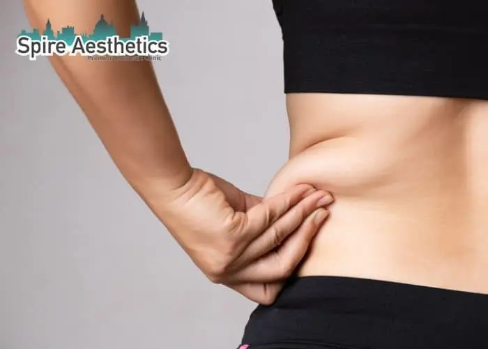 Image of woman pinching fat on their hips Hampton. Fat Freezing treatment 