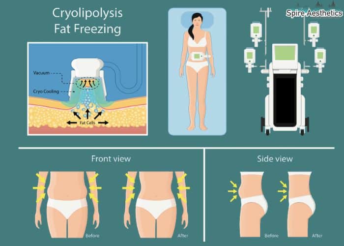 Image of diet and fat freezing combined for best results for Spire Aesthetics Hampton