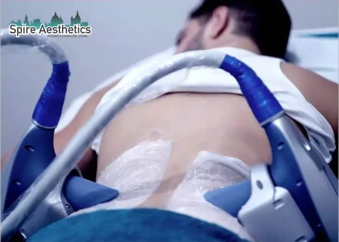 Man having fat freezing treatment done on love handles before a competitions Hampton to create a sculpted look.