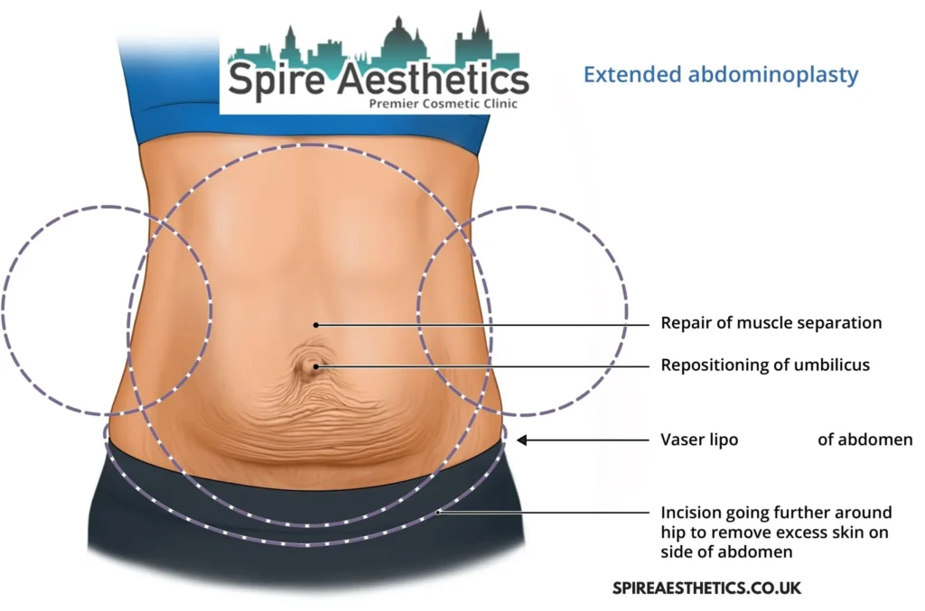 Understanding Loose Skin After Gastric Band Hampton Surgery and HIFU Treatment 