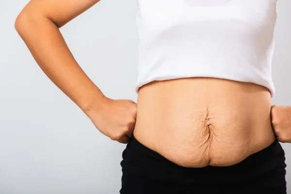 Image of a woman's stomach after weight loss with sagging skin following a gastric band Hampton