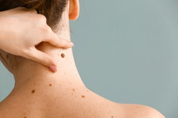skin blemish removal Hampton treatment