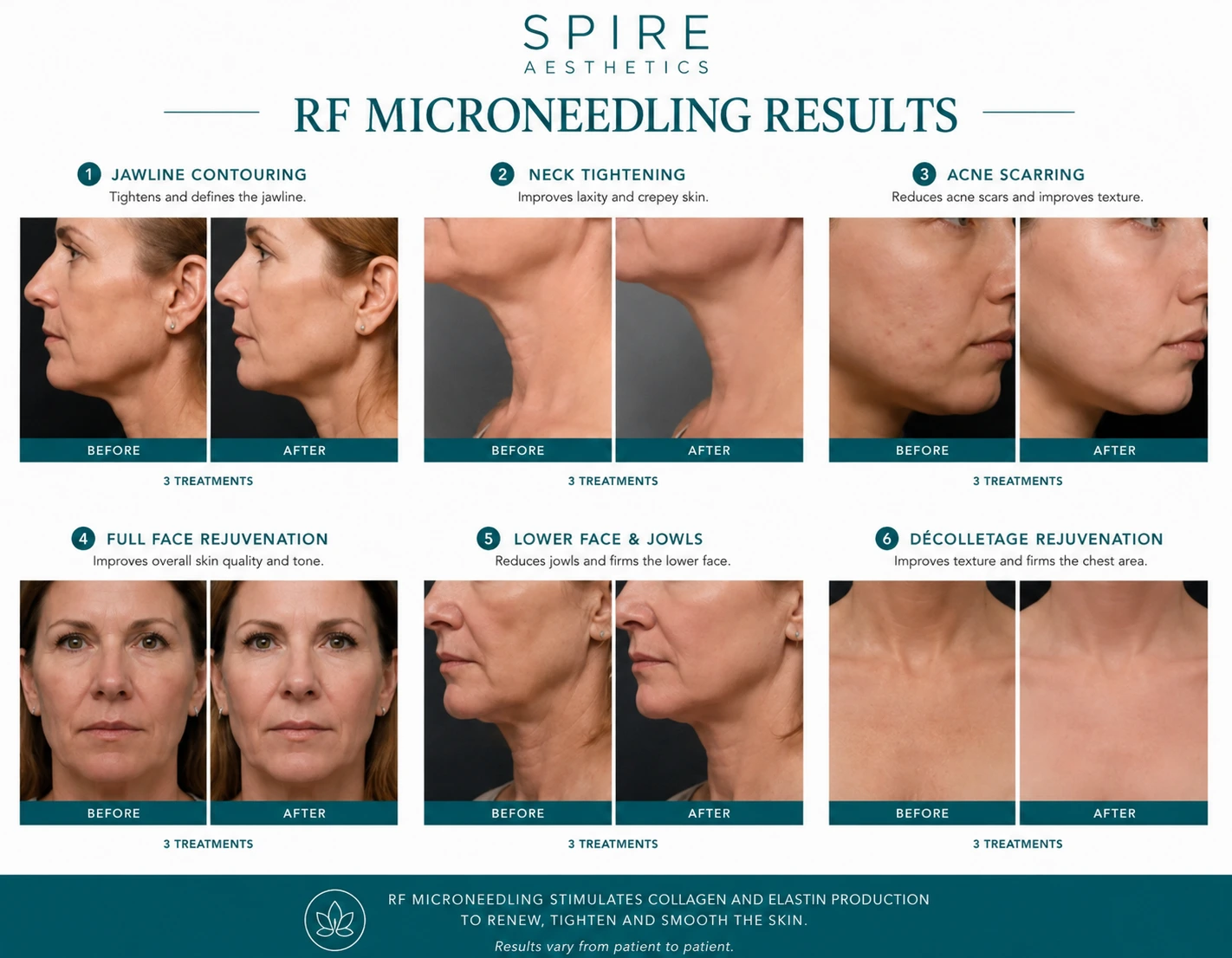 RF Microneedling Skin tightening Hampton results