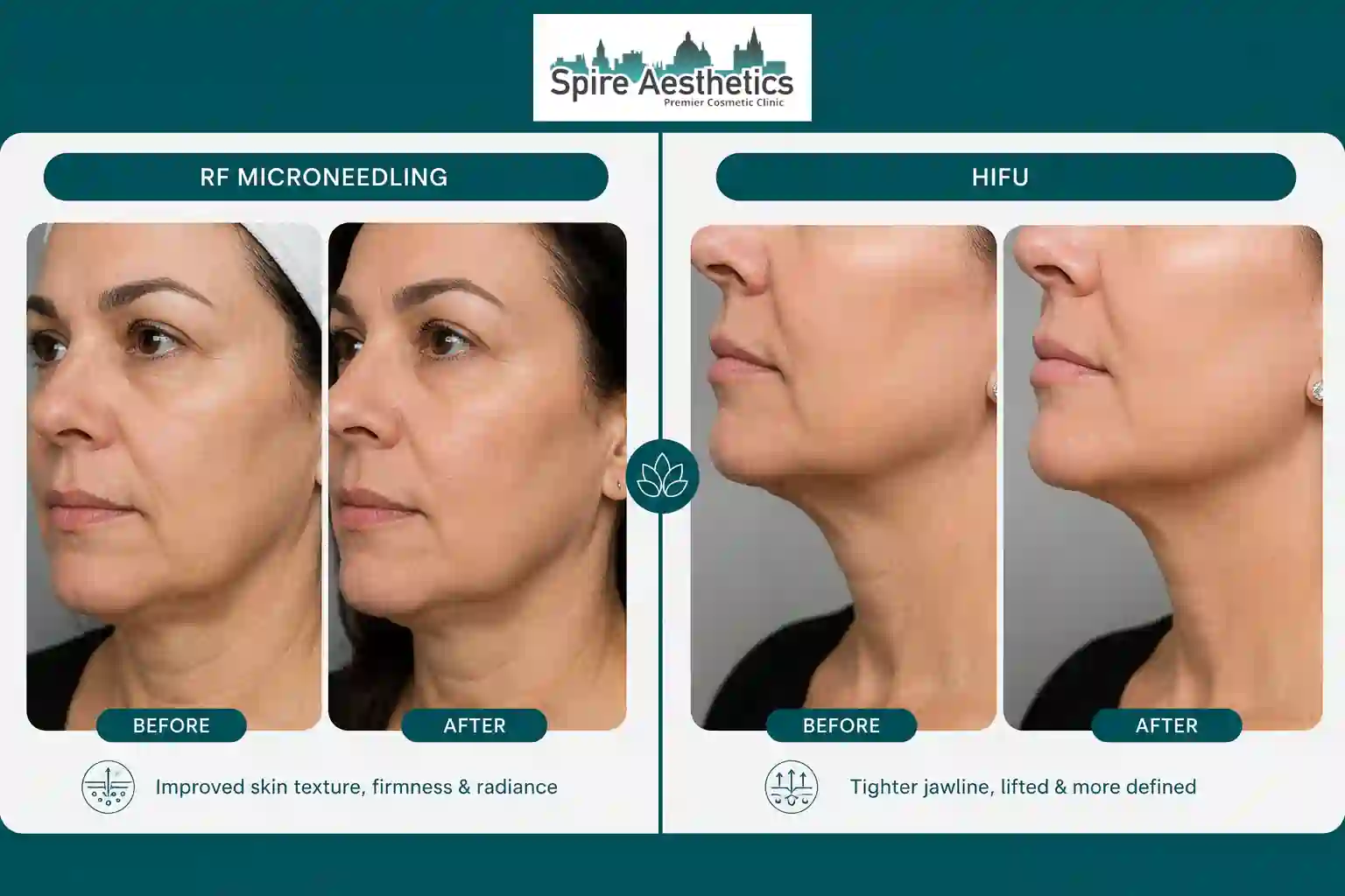 Can RF Microneedling and HIFU Be Combined Hampton?