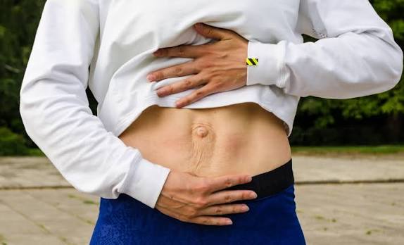 When Could Diastasis Recti Be the Missing Piece of the Puzzle Hampton?