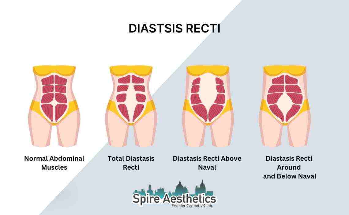 Is Non-Surgical Diastasis Recti Treatment Right for You? Common Concerns Answered Hampton